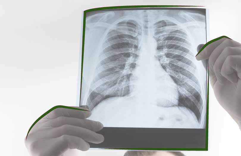 Смертность от туберкулёза